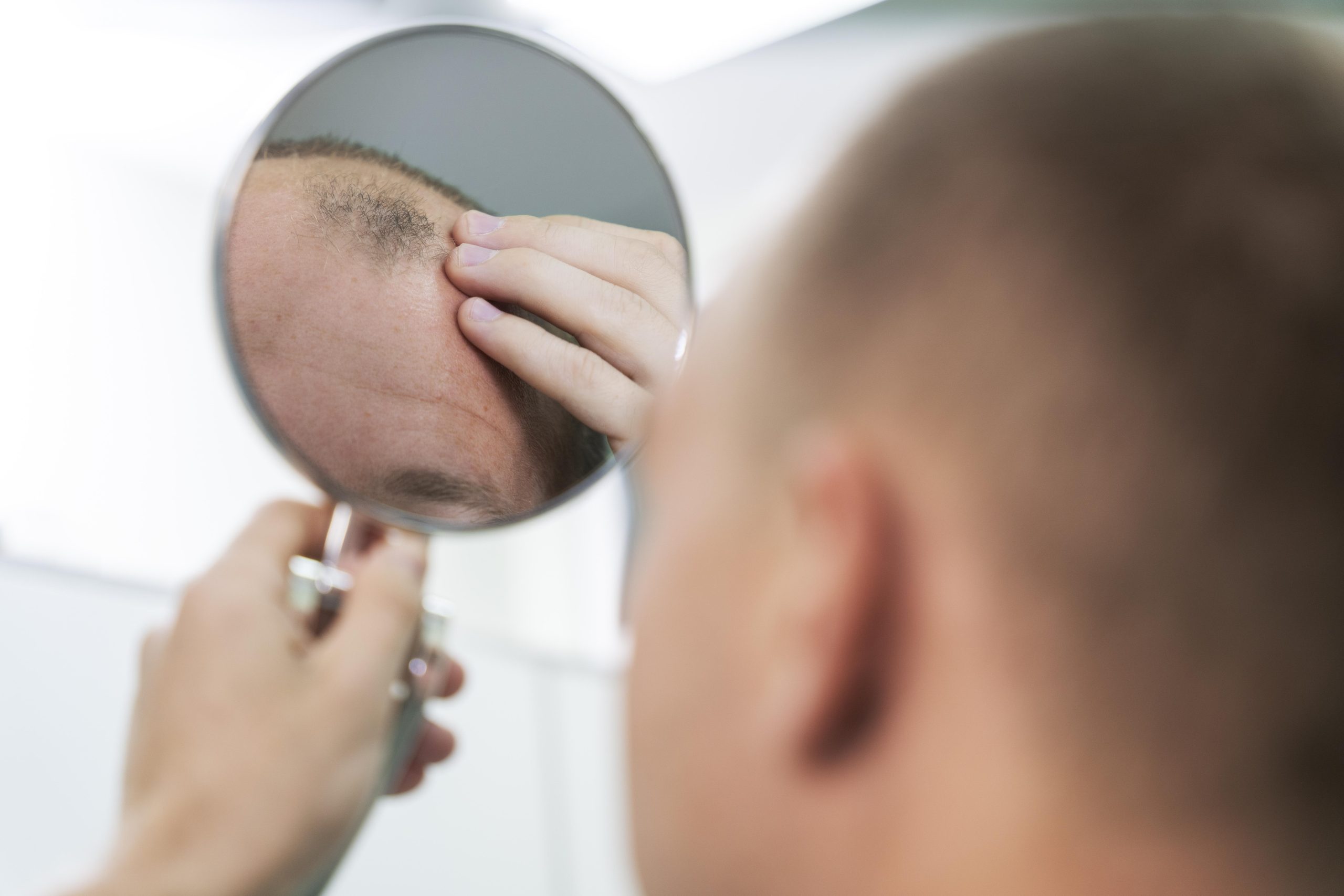 adult-male-having-balding-problems