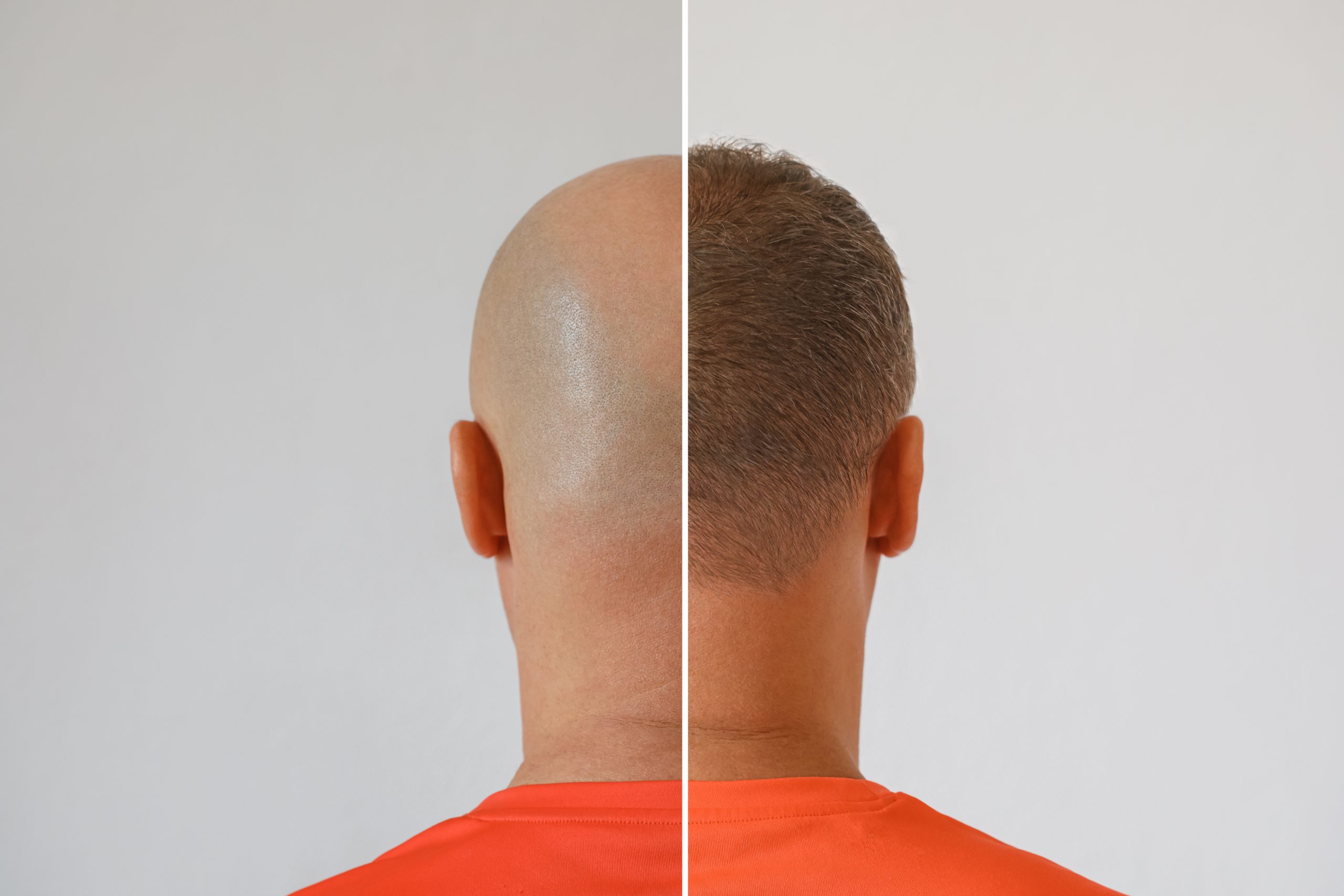 The head of a balding man before and after hair transplant surgery. A man losing his hair has become shaggy. An advertising poster for a hair transplant clinic. Treatment of baldness.