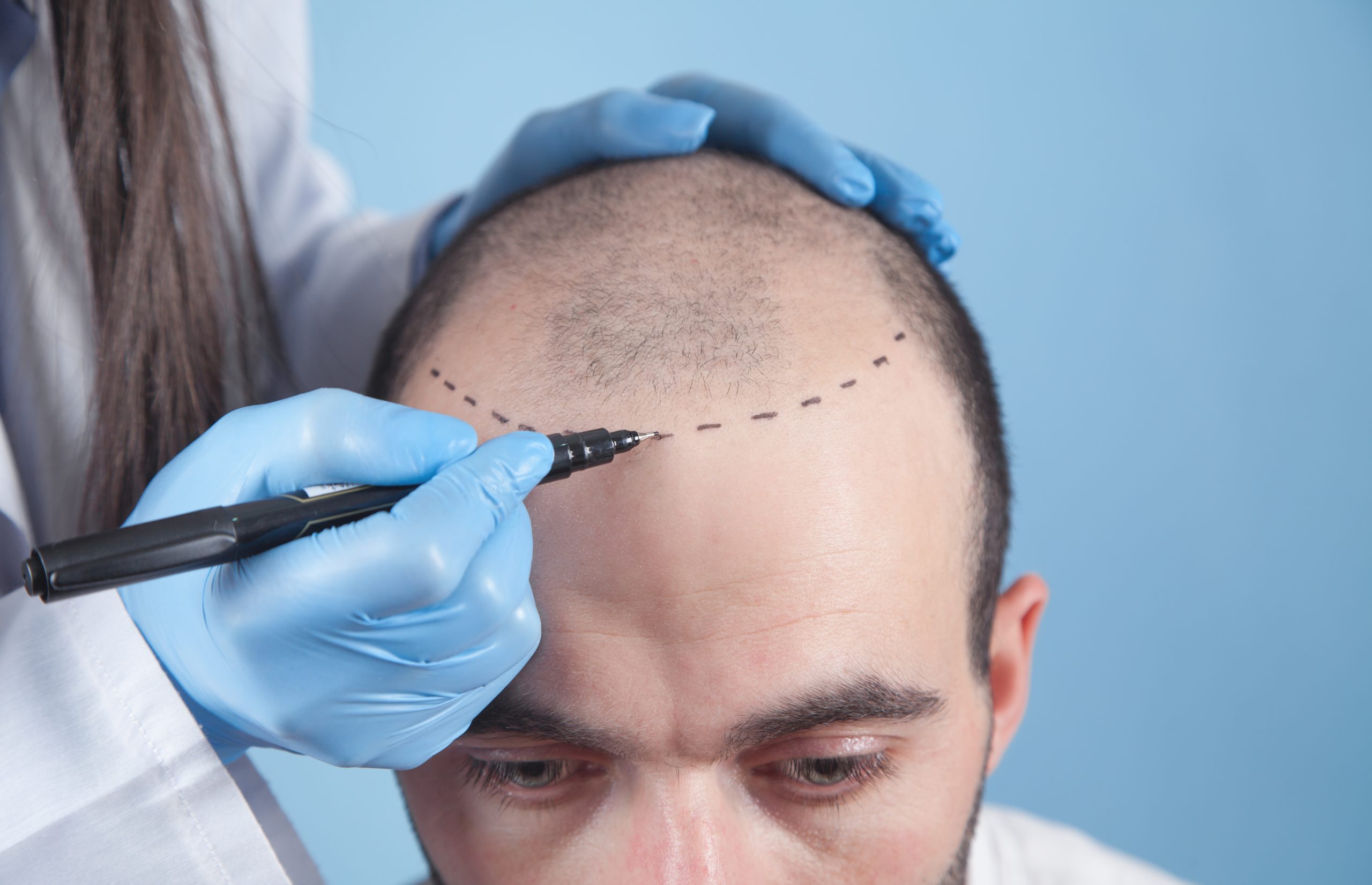 Patient suffering from hair loss in consultation with a doctor.