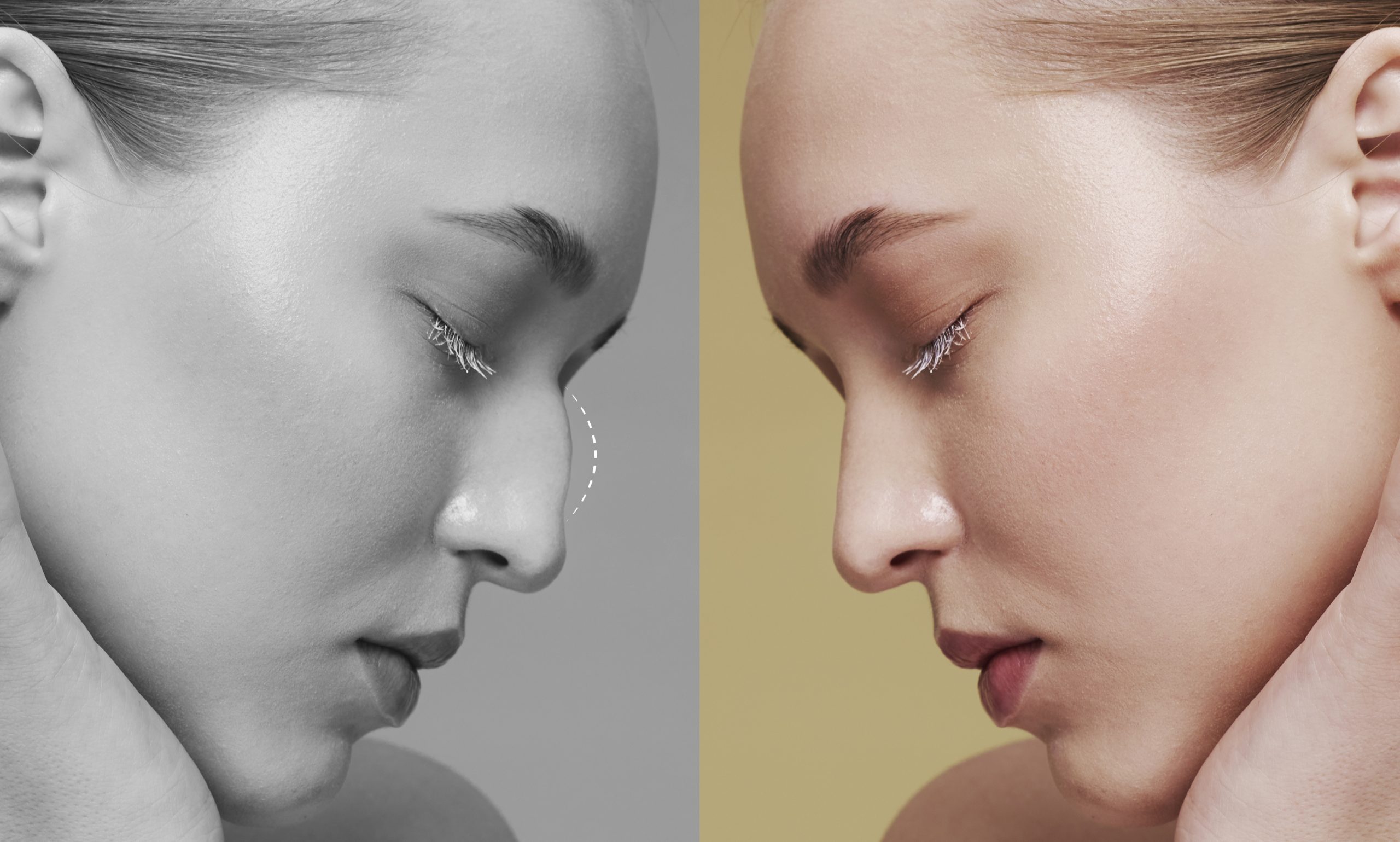 side-view-young-woman-before-after-rhinoplasty