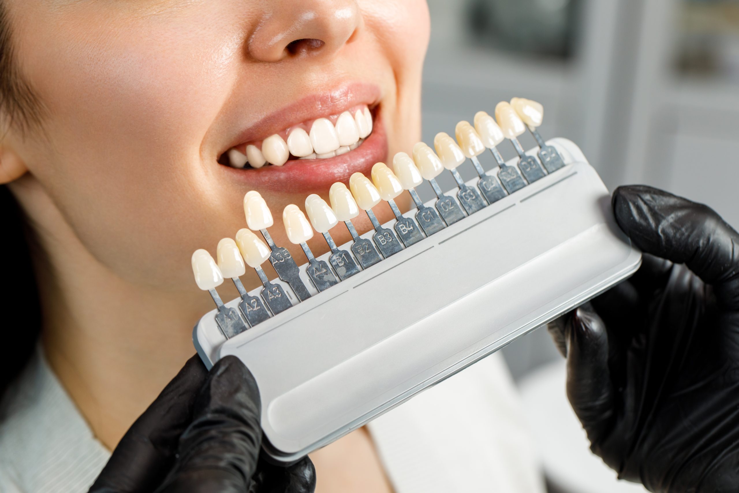 Smiling young woman. Cosmetological teeth whitening in a dental clinic. selection of the tone of the implant tooth