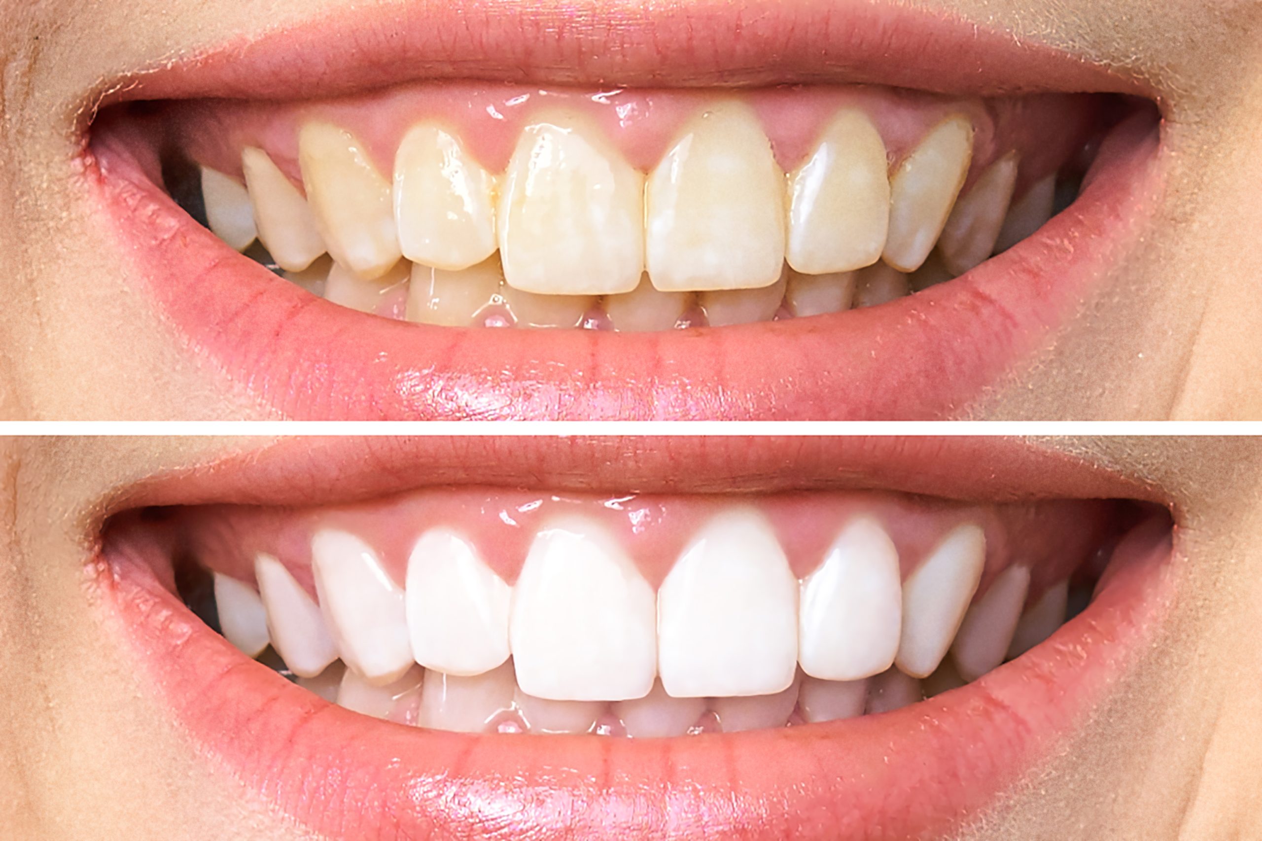 woman teeth before and after whitening. Over white background. Dental clinic patient. Image symbolizes oral care dentistry, stomatology