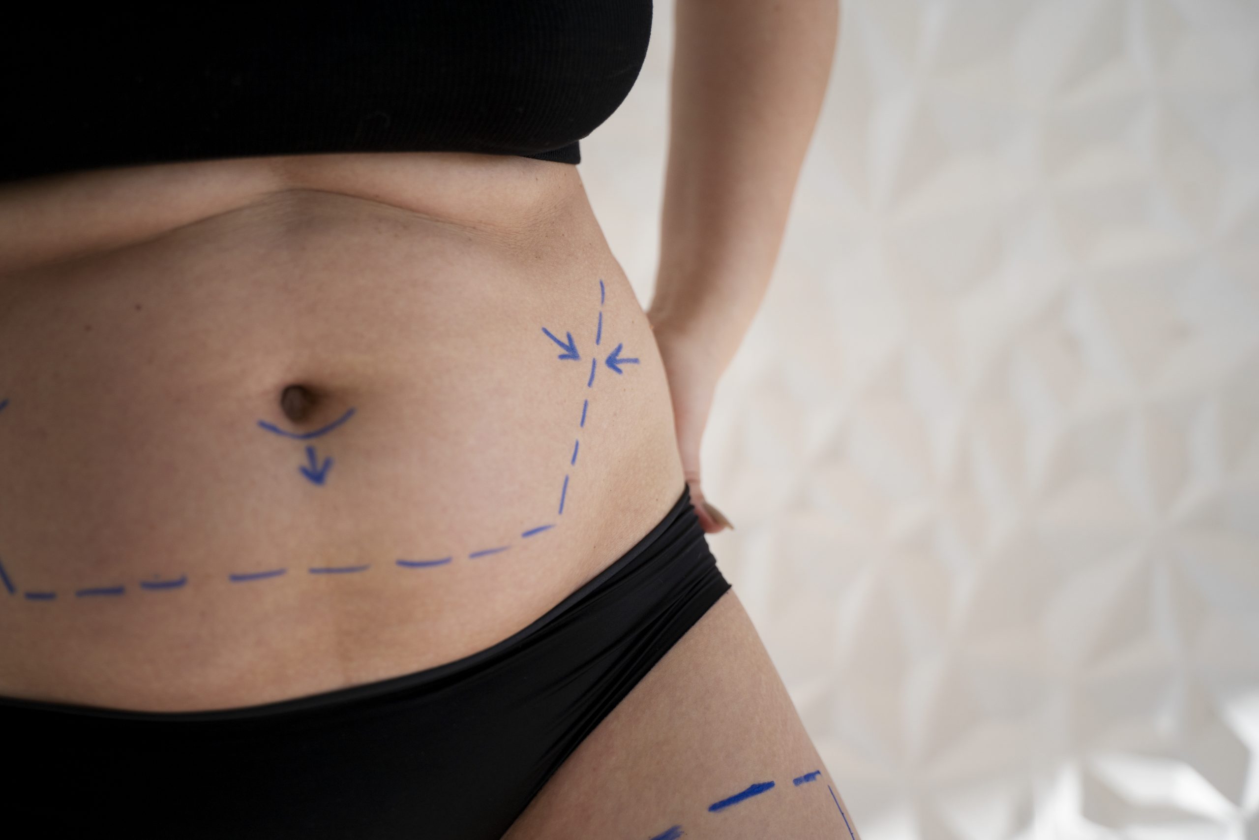 woman-s-body-with-marker-traces-close-up